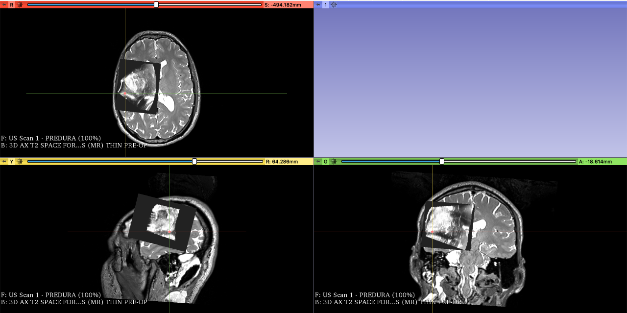 Picture of the pre-dura Ultrasound scan on top of the MRI scan showing the same fiducial on the sulcus