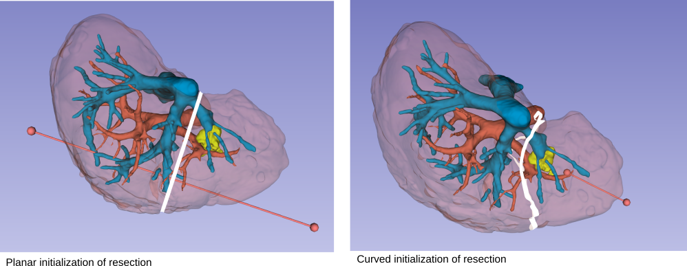 Resection initialization